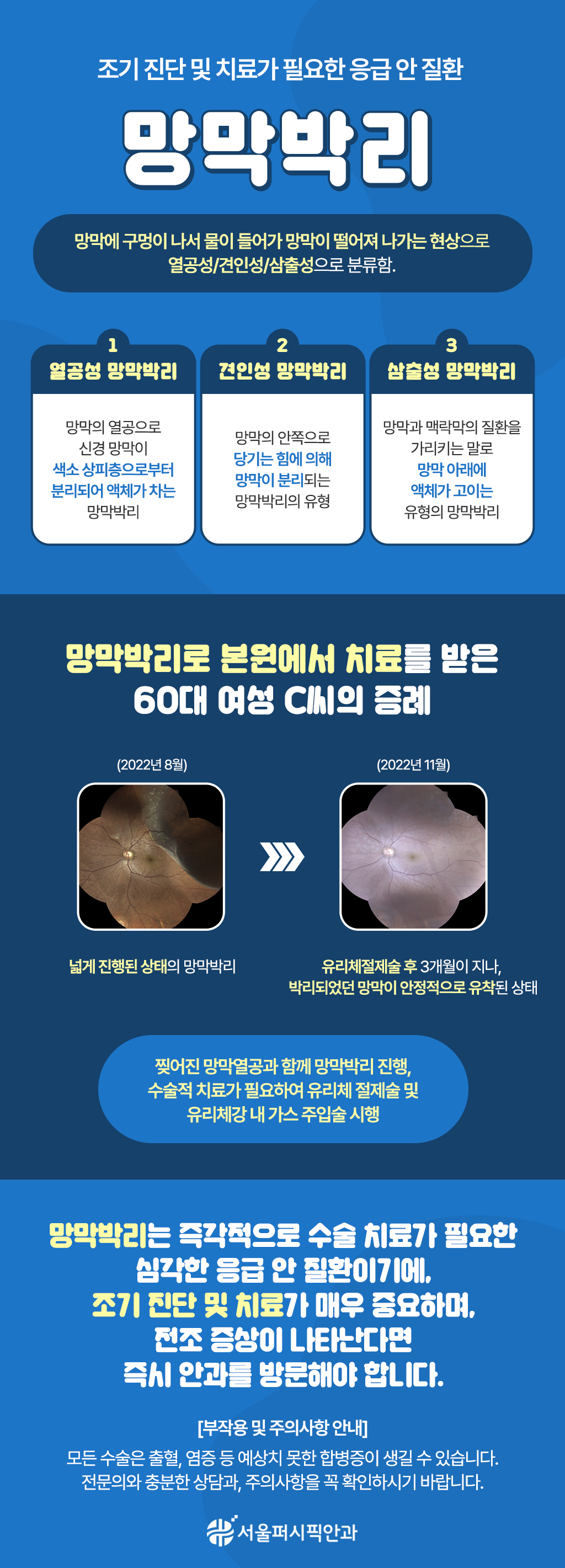 221216_서울퍼시픽안과_21차웹배너(망막박리).jpg